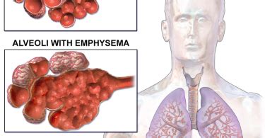 Emphysema Signs and Symptoms Archives - Pediaa.Com