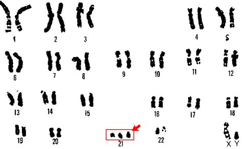 Definition > Trisomy 21 - Down's Syndrome