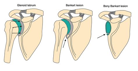 Shoulder Dislocation – OrthoSHO