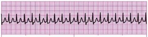 Supraventricular Tachycardia