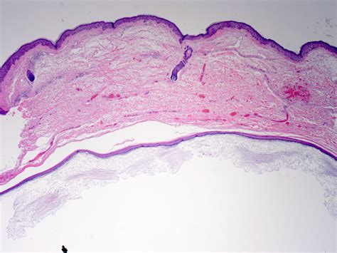 Pedicab Énfasis crisantemo pilar cyst histology índice novato Condición