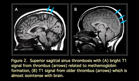 MRI BLOG: Dural Sinus Thrombosis