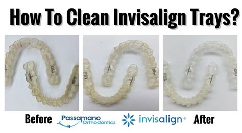 How to Clean a Crusty Invisalign Tray or Retainer at Home | How to ...