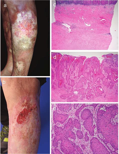 Development of cutaneous squamous cell carcinoma (cSCC) in a... | Download Scientific Diagram