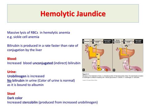 PPT - Bilirubin Metabolism & Jaundice PowerPoint Presentation, free download - ID:2728598