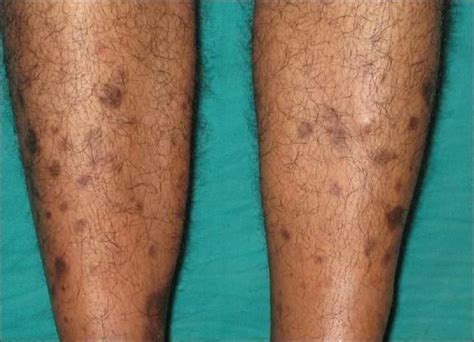 ”Diabetic shin spots/ Diabetic Dermopathy” – Platform | CME