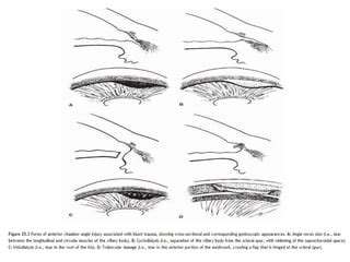 Angle recession glaucoma | PPT