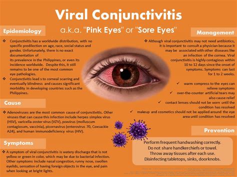 What is Viral Conjunctivitis a.k.a. Sore Eyes? | National Institutes of ...