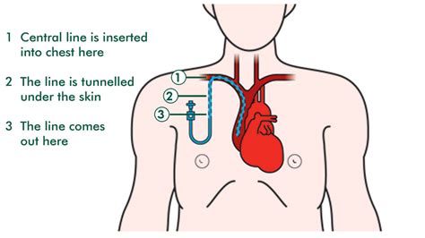 Parts Of Central Catheter