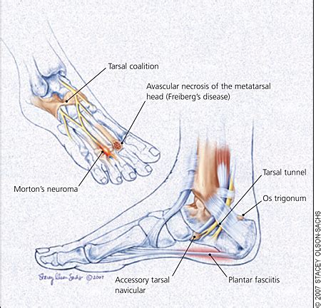 Foot Pain Diagnosis Diagram