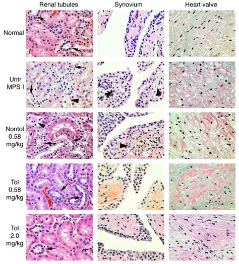 Mucopolysaccharidosis I; Hurler's Syndrome; Pfaundler-Hurler Syndrome ...