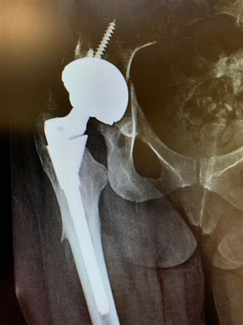 Case Study: Hip dislocation treatment – Acetabular component exchange in total hip replacement ...