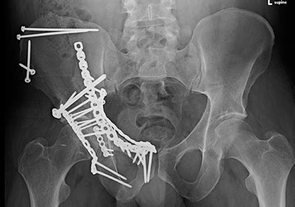 Posterior Wall Acetabular Fracture (Broken Hip Socket) | Orthopaedic ...