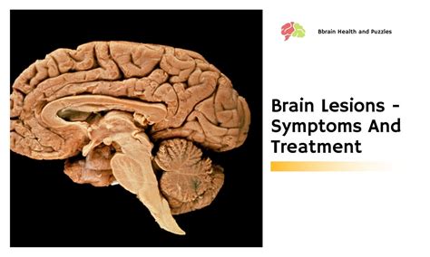 Brain Lesions - Symptoms And Treatment | Brain Health and Puzzles