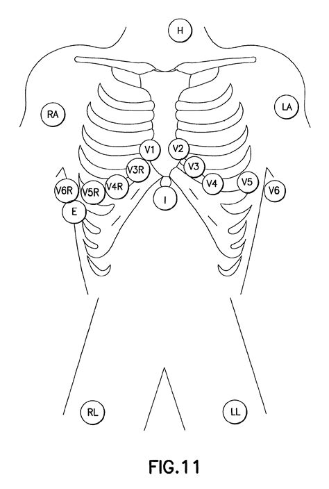 Diagram Pediatric Ekg 15 Lead Placement Diagram Full Version Hd | Images and Photos finder