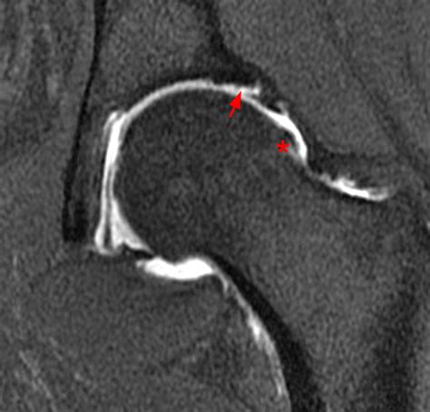 Postoperative Hip MRI in Patients Treated for FAI | Radsource