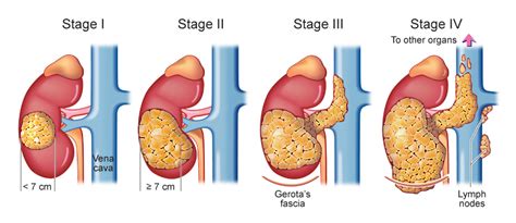 Renal Cell Carcinoma - Renal Cancer | Kimaja Farwani.