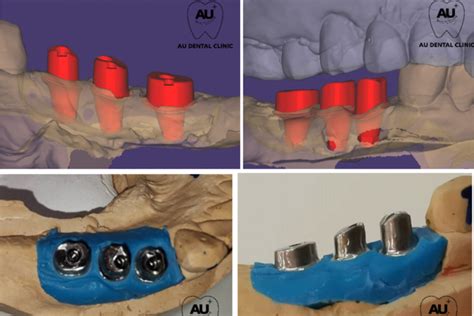 What is a ‘Customized Abutment’? – AU Dental