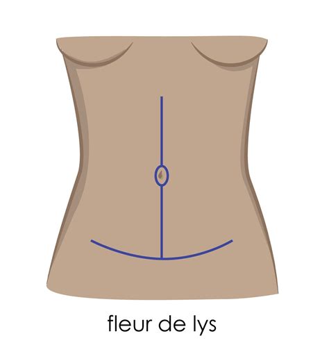 Panniculectomy Vs Tummy Tuck