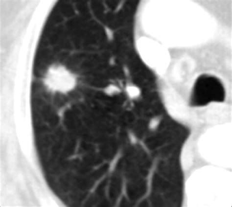 Pulmonary nodule with lobulated margins. Figure 6. Benign granuloma... | Download Scientific Diagram