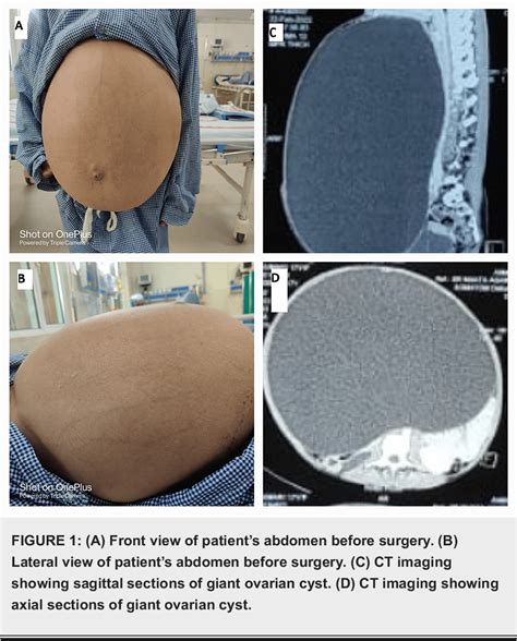 Figure 1 from Complete Laparoscopic Ovarian Cystectomy of Giant Ovarian Serous Cystadenoma ...