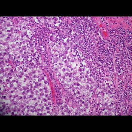 Testicular seminoma (histology) | Radiology Case | Radiopaedia.org