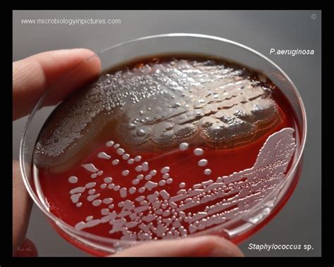 Blood agar plate with Pseudomonas aeruginosa and coagulase negative staphylococci. Appearance ...