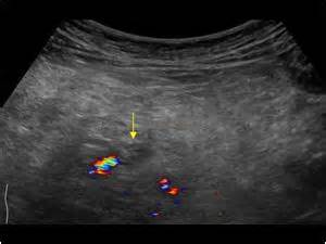 Abdomen and retroperitoneum | 1.7 Peritoneum mesentery and omentum ...