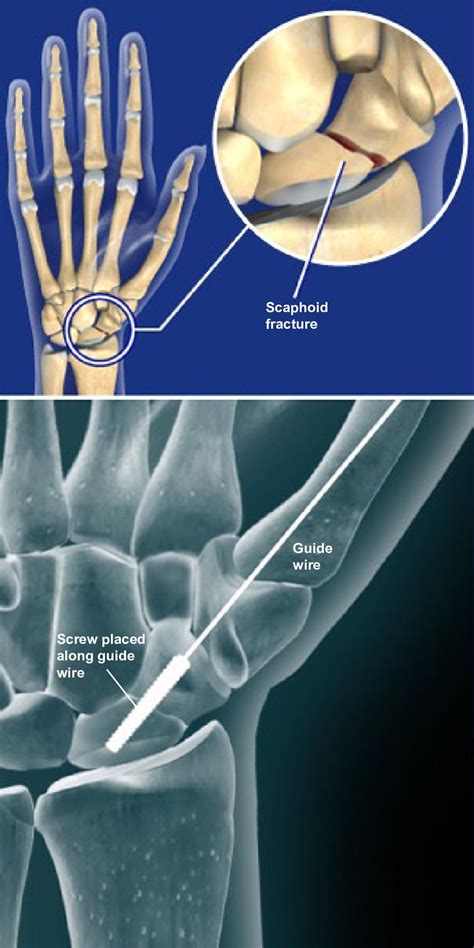 Scaphoid Fracture Cast Time