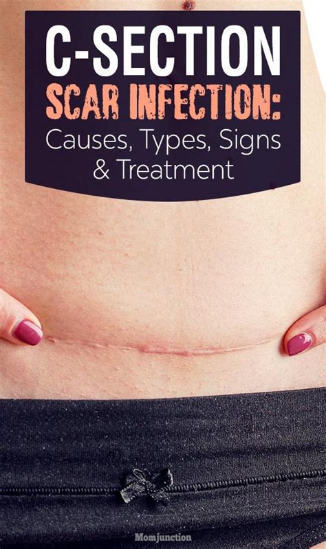 C-Section Scar Infection: Causes, Types, Signs And Treatment