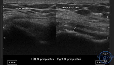 Rotator Cuff Tears - Ultrasound First