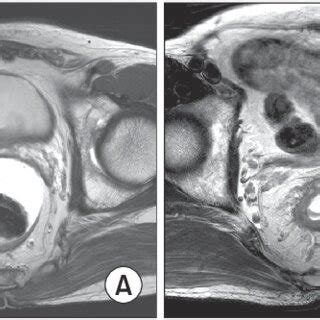 The MRIs of rectal cancer. (A) Rectal cancer with T2N1. (B) Rectal ...