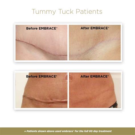 Embrace Active Scar Defense for New Tummy Tuck Scars, FDA-Cleared Extra ...