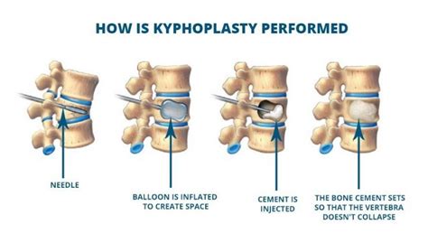 KYPHOPLASTY FOR COMPRESSION FRACTURES | Total Spine & Brain Institute