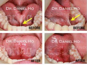 Frenectomy & Vestibuloplasty - Spring Periodontics