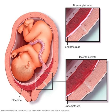 Placenta accreta - Symptoms and causes - Mayo Clinic