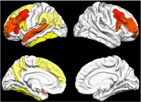 Colored cortical regions demonstrating differences between patients... | Download Scientific Diagram