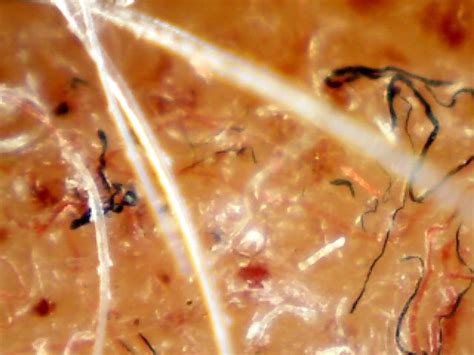 What is Morgellons Disease | The Charles E. Holman Foundation