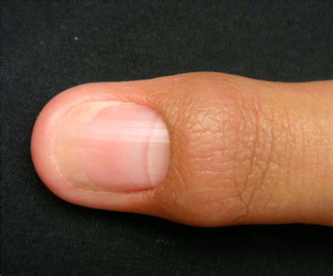 Retronychia Treated with Proximal Nail Avulsion; two Cases Successfully Treated with this ...