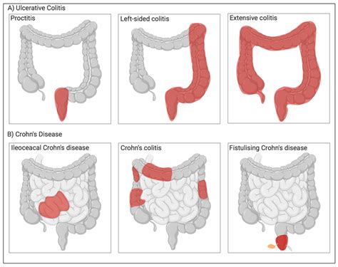 Different types of Inflammatory Bowel diseases. (A) Ulcerative colitis ...