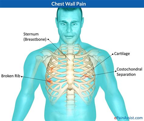 Pin on CostoChondritis