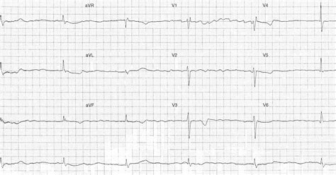 ECG of the Week: ECG of the Week - 17th September 2018 - Interpretation