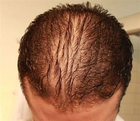 Diffuse Hair Loss Treatment in Surat | ID: 9974548955