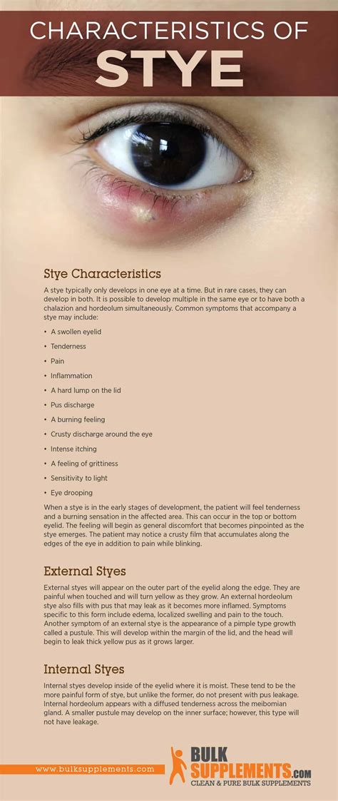 Tablo | Read 'Stye: Characteristics, Causes & Treatment' by