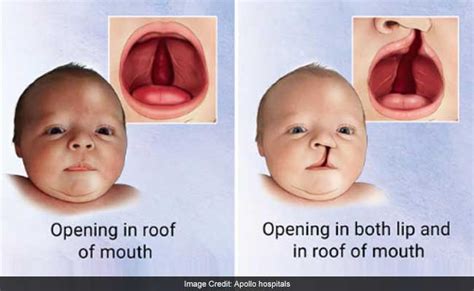 India Has Over 72,000 With Cleft Lip And Palate