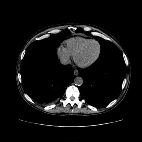 Tutorial chest CTA - Thorax CTs - embodi3D.com