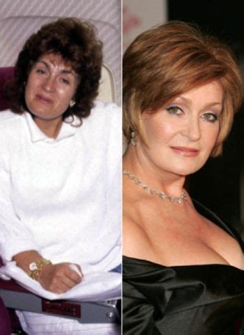 Sharon Osbourne Plastic Surgery Before and After