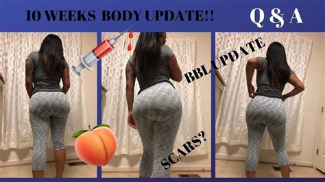 POST BBL FAQ: Q& A 10 week post op bbl - YouTube