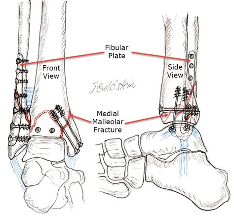 Complete Fracture Ankle