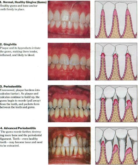 Explicação do exame Periodontal - All Heart Dental | Hispanic Net